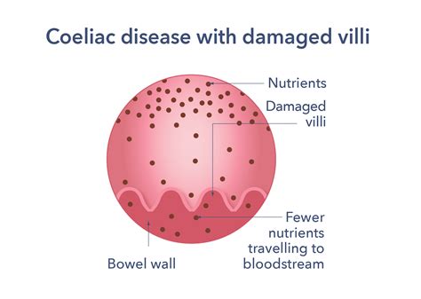 Coeliac Disease Causes Symptoms Treatment And Support Guts Uk