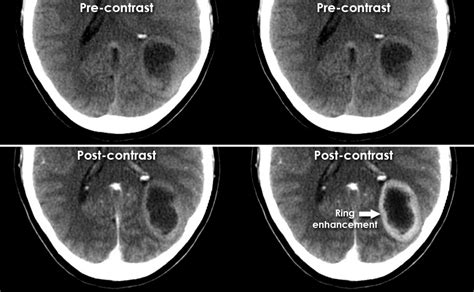 Ct Brain Image Gallery Glioma V Cerebral Abscess