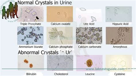 Crystals In Urine Causes Symptoms And Treatment A Comprehensive Guide