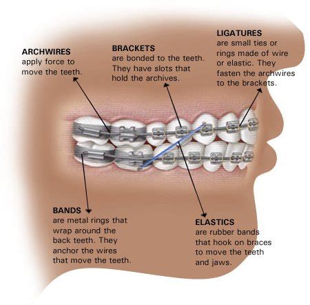 Home Care For Braces Milford Nh