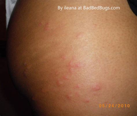 What Do Bed Bugs Bites Look Like Like This