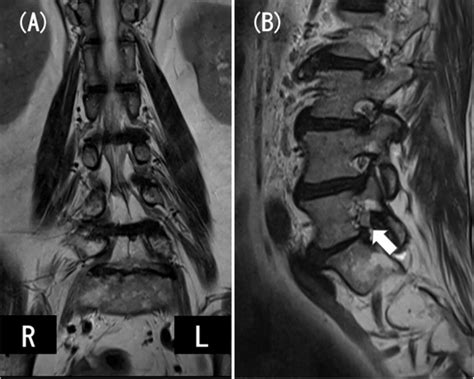 Successful Visualization Of Dynamic Change Of Lumbar Nerve Root