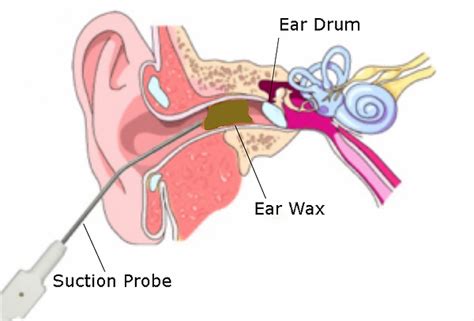Microsuction Ear Wax Removal The Audiology Clinic