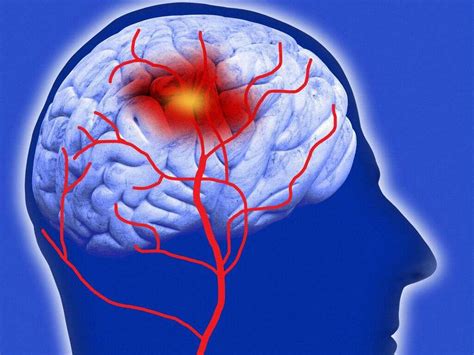 Cerebrovascular Accident What Is Cerebrovascular Accident