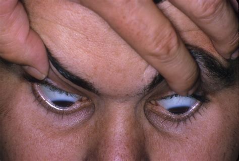 Keratoconus 3 Hereditary Ocular Diseases