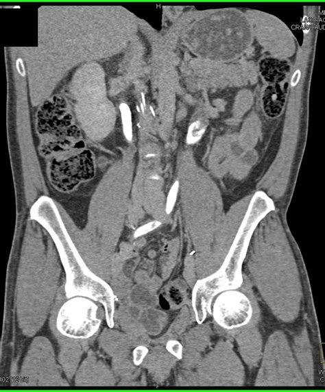 Transitional Cell Cancer Tcc Recurrence In Left Ureter And Renal