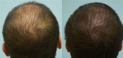 Finasteride Before And After Photos [2022]