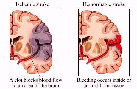 Aside from the cerebrum, there are subcortical structures that lie deep within the brain. Hemorrhagic Stroke-Treatment, Symptoms, Prognosis, Recovery