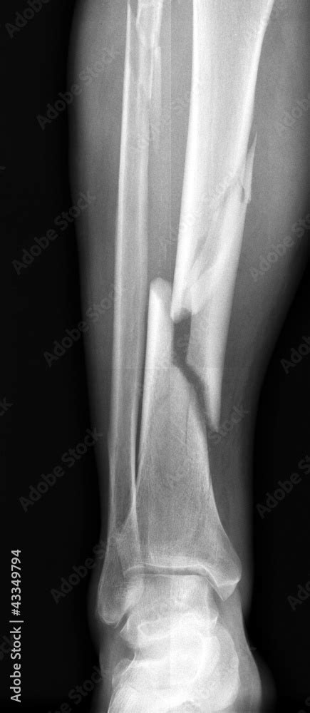 X Ray Of Broken Leg Stock Photo Adobe Stock