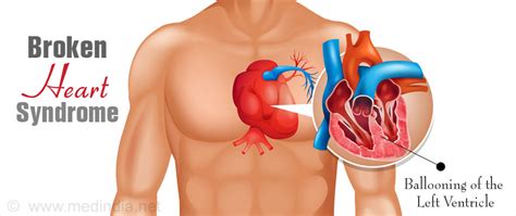 Broken Heart Syndrome Takotsubo Syndrome Tts Causes Symptoms Diagnosis And Treatment