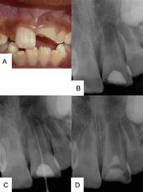 A Intraoral Front View Of The Patient In Occlusion B Pre Operative
