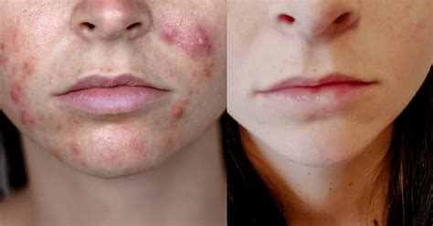 Spironolactone For Acne Complete Guide My Experience