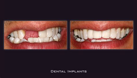 Nelsen family dentistry provides comprehensive dental care in chico, ca. Dental_Implants | ofazomi.org
