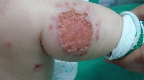 Skin Ulcer Pictures Symptoms Causes Stages Treatment Prevention My
