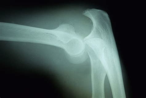 Elbow Dislocation Causes Symptoms And Treatment