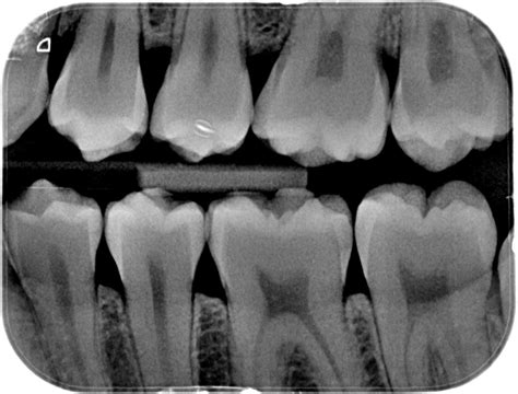 See more ideas about dental, dentistry, radiography. Dental X-rays | Drummoyne Dental Practice