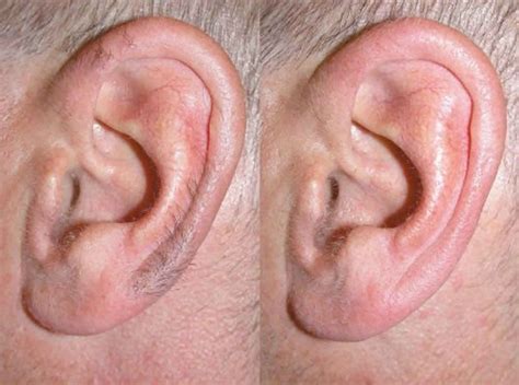 Ear Hair Function And Ear Hair Removal Techniques