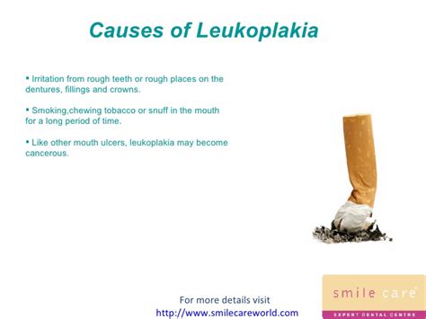 Read and know what is leukoplakia as well as all about its causes, symptoms, diagnosis, treatment and. Leukoplakia