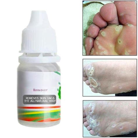 10ml body warts mole removal liquid skin tag remover foot warts remover sancys thaipick