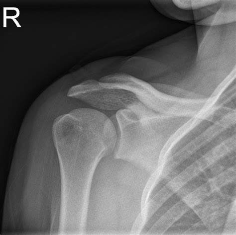 Normal Shoulder Buyxraysonline