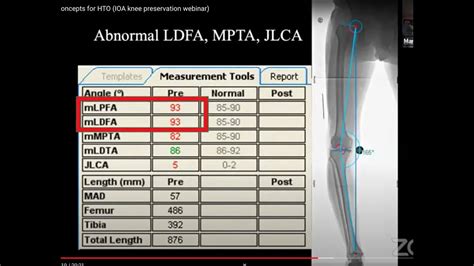 Basic Deformity Concepts For Hto Ioa Knee Preservation Webinar Youtube