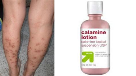 How To Get Rid Of Old Scars From Mosquito Bites Howotremvo