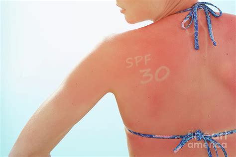 Woman With Sunburnt Back Photograph By Science Photo Library