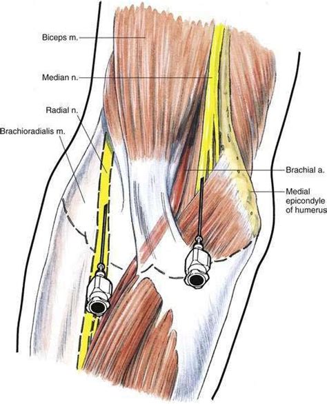 Distal Upper Extremity Block Clinical Gate