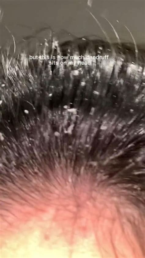 This Is A Real Issue🥲 Do You Struggle With Dandruff Hair Maintenance