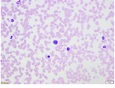 Peripheral Blood Smear Showing Circulating Lymphoma Cells Download
