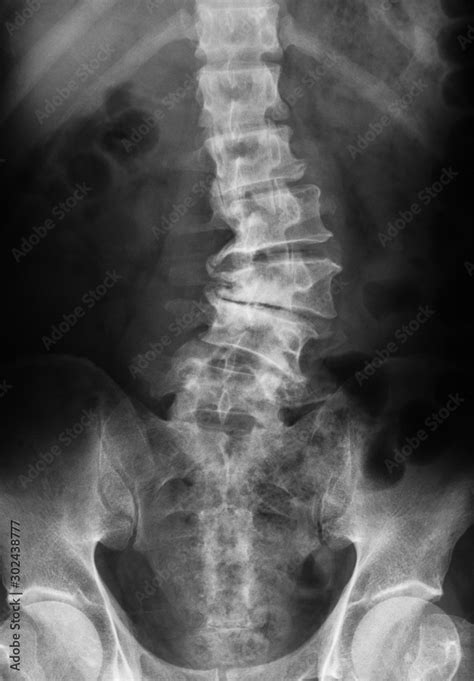 Spondilosis Cervical X Ray Hot Sex Picture