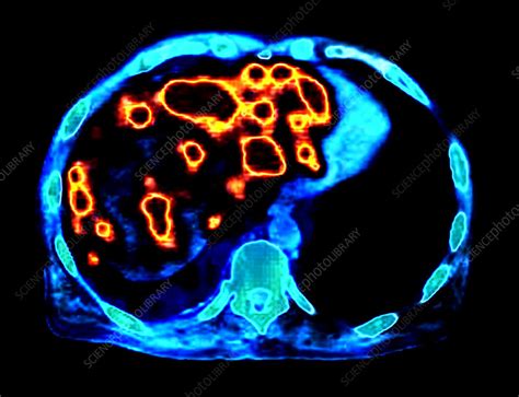 Liver Metastases Pet Ct Scan Stock Image C0174433 Science