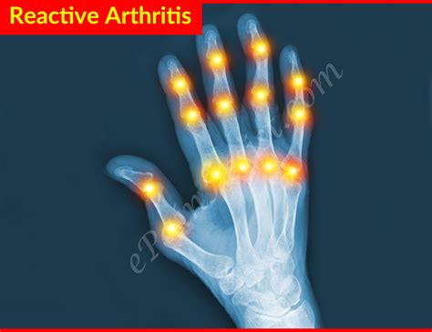 Reactive Arthritiscausesrisk Factorsinvestigationstreatmentprevention