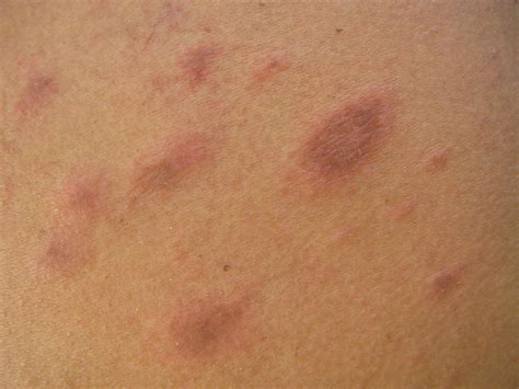 Pityriasis Rosea Benign Skin Rash That May Inflict Substantial Discomfort In Certain Cases