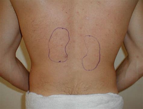 Kidney Pain Location Pictures Symptoms Causes Diagnosis