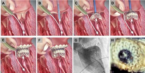Highlife Transcatheter Mitral Valve Replacement System The