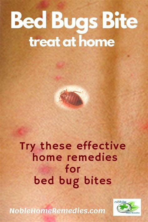 How To Treat Bed Bugs Bites On Skin Heal Mania