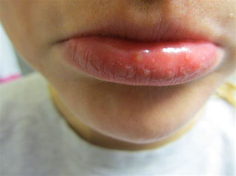 Pickel auf der lippe hallo alle miteinander. Komisches Ding IN der Unterlippe? (Gesundheit, Gesicht, Lippe)