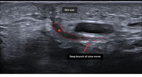 Figure 2 From Injury Of The Deep Branch Of The Ulnar Nerve A