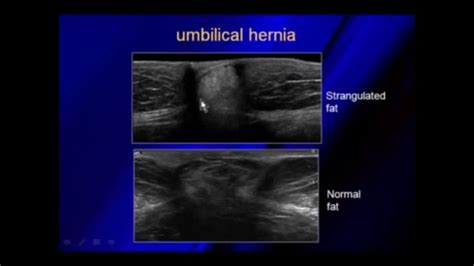 Ultrasound Of Hernias Umbilical Hernia Ultrasound Fluid Images And