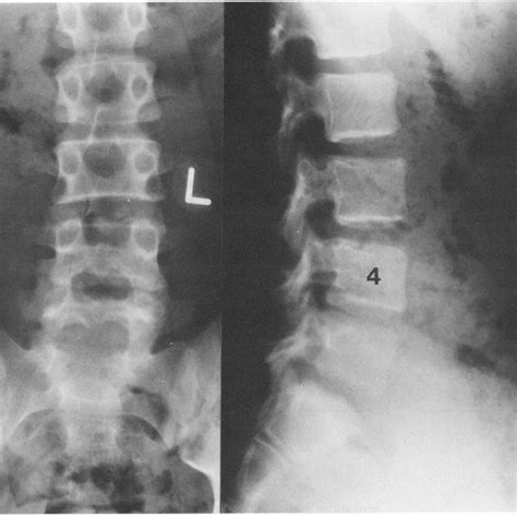 Anteroposterior And Lateral Radiographs Of The Lumbar Spine A Decrease