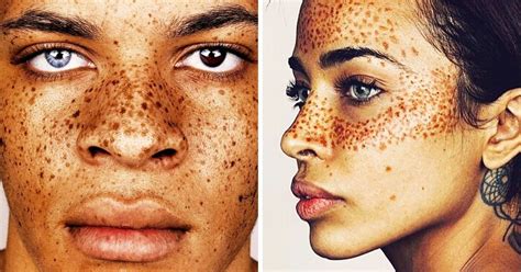 An English Photographer Captures The Beauty Of People With Unique Skin