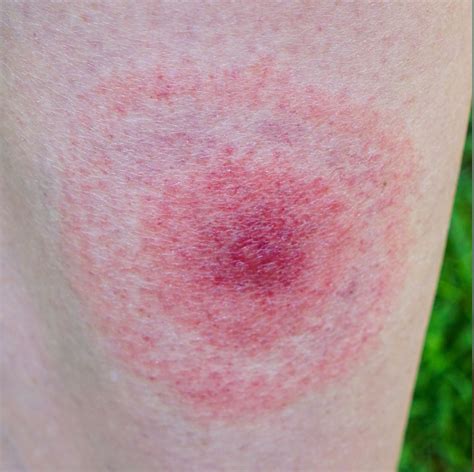 These Pictures Will Help You Id The Most Common Bug Bites This Summer Bed Bug Bites Pictures