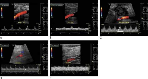Spectral Doppler Waveforms In The Setting Of LVADs A Monophasic