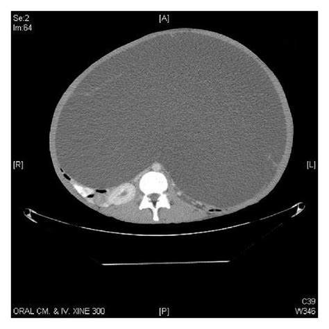Axial And Coronal Computerized Tomography Ct Scan Images Showing A