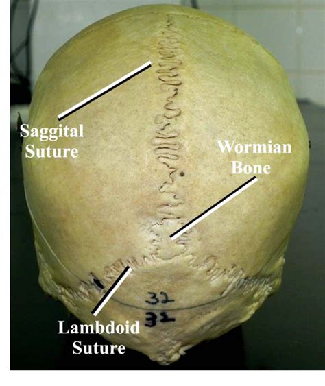 Figure 6 From Wormian Bones A Review Semantic Scholar