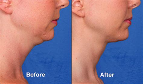 Kybella Injections For Double Chin Oxnard Ventura County