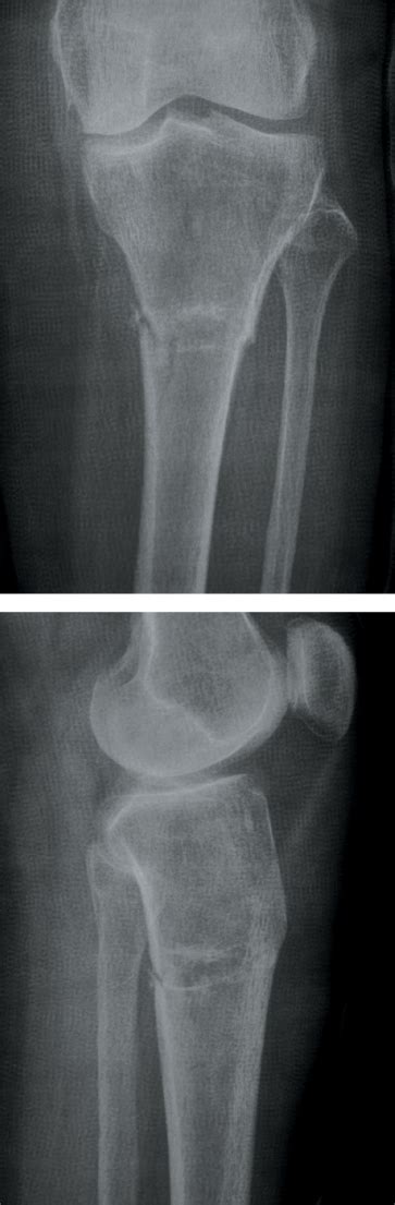 Tibia And Fibula Diaphyseal Fractures Musculoskeletal Key