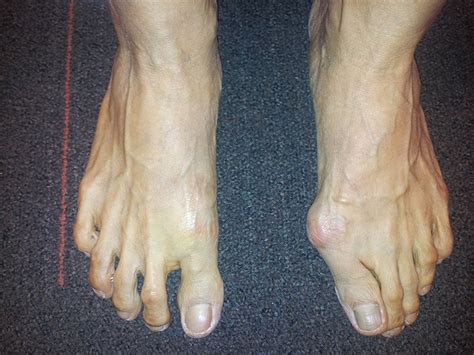 Foot Deformities Singaporesurgery Reconstructioncorrection