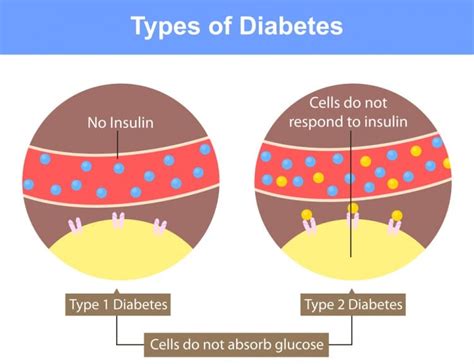 New Scheme To Prevent Type 2 Diabetes - The Best Of Health